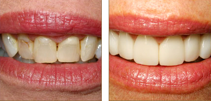 Before and after veneers - a speciality at Aquila Dental